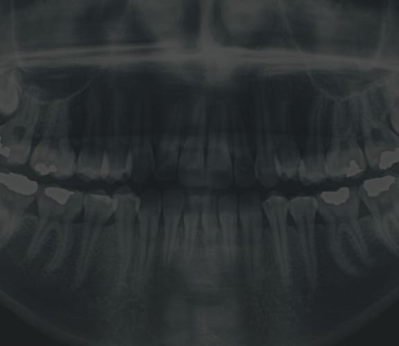 Panoramic X-Ray of teeth