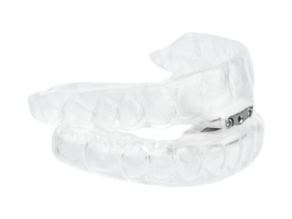 A side view of the tap3 appliance mouthguard